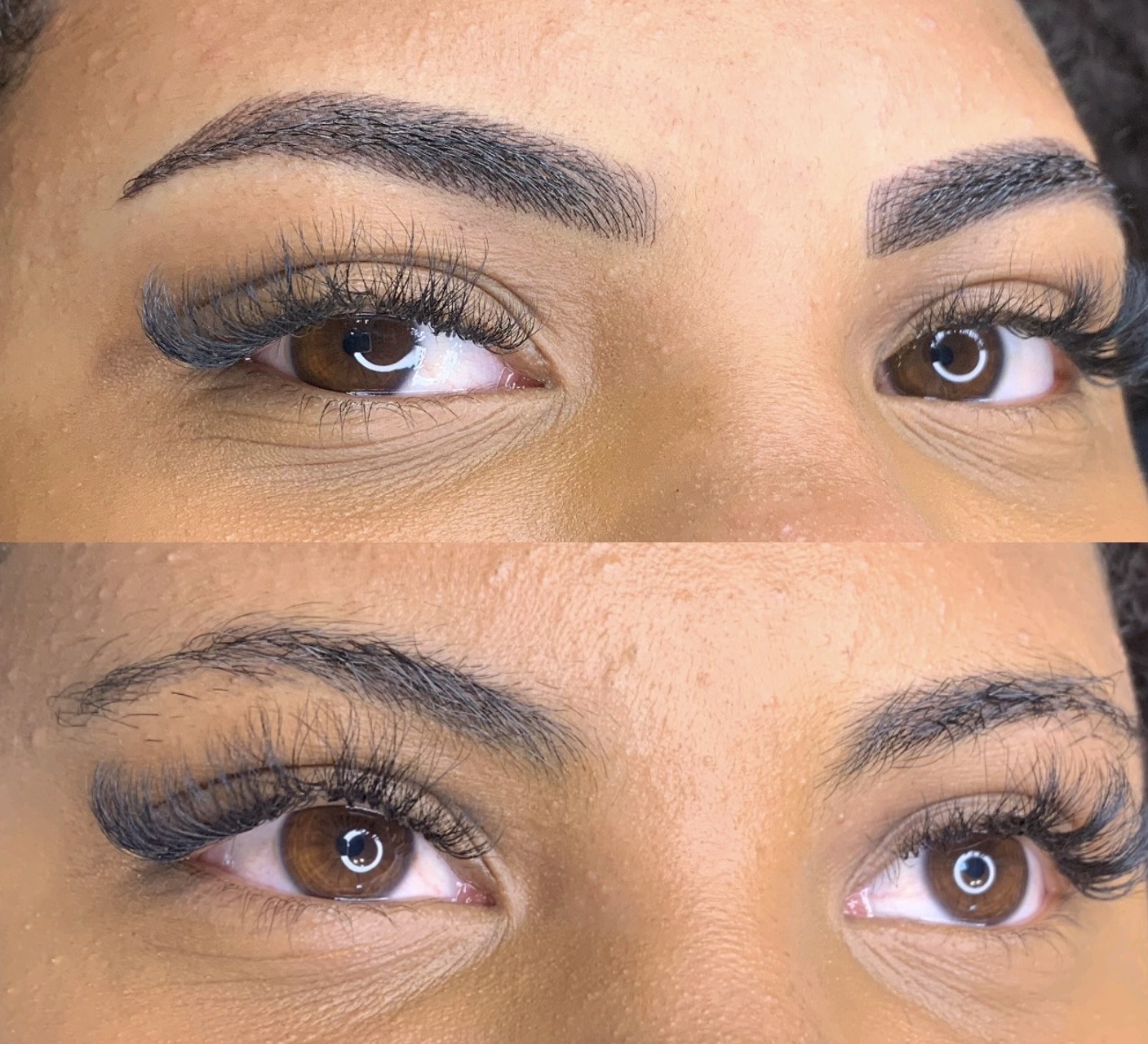 Resultado de remoção a laser